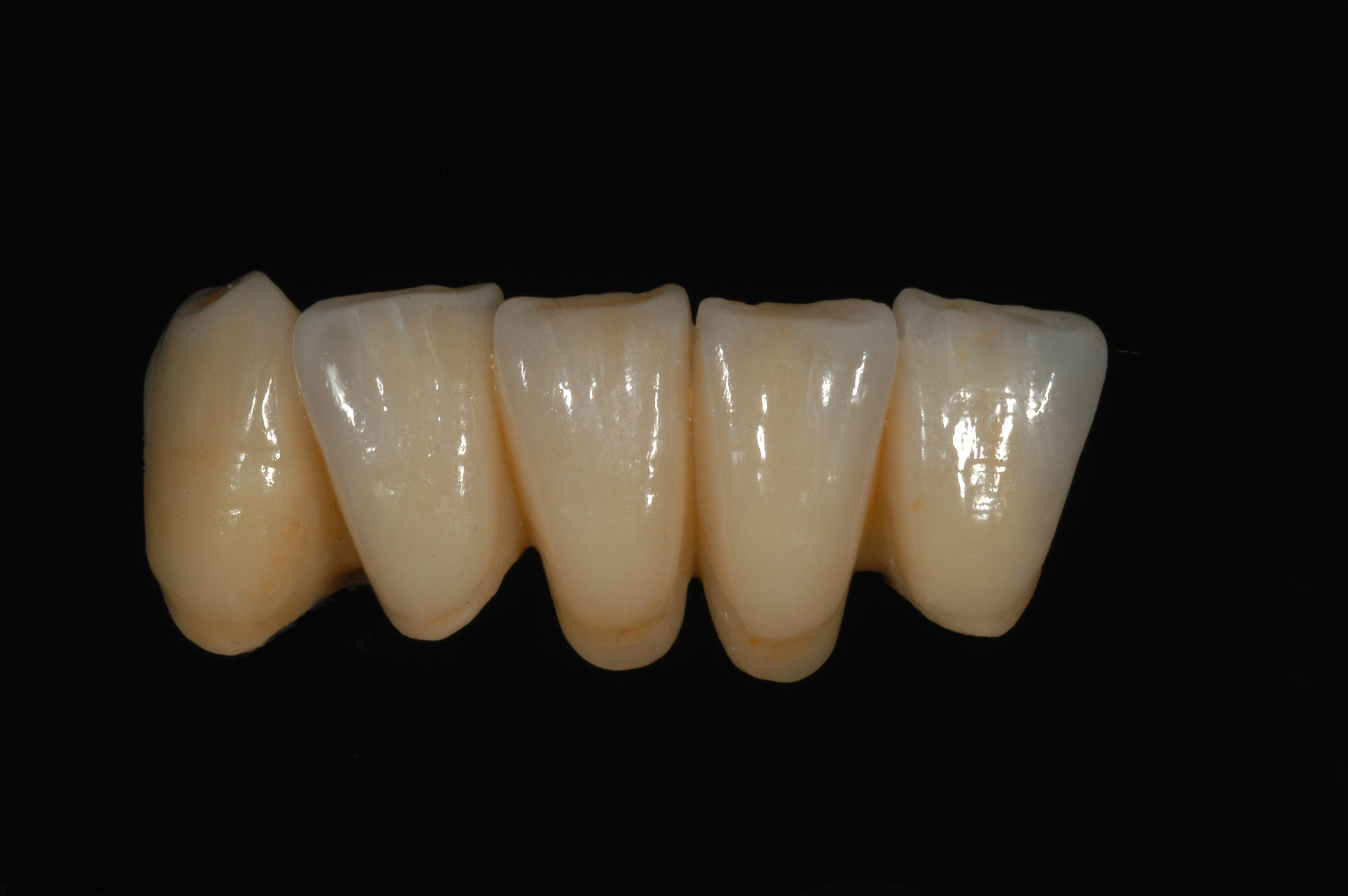 Brücke für den Unterkiefer aus Zirkon von ADU-Dental