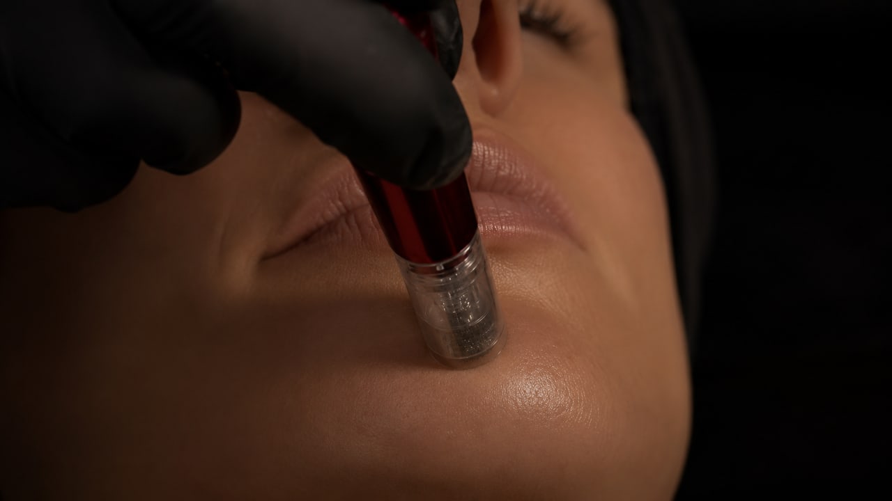 BLACK SWON Edition des Microneedlings bei SWON in Pforzheim