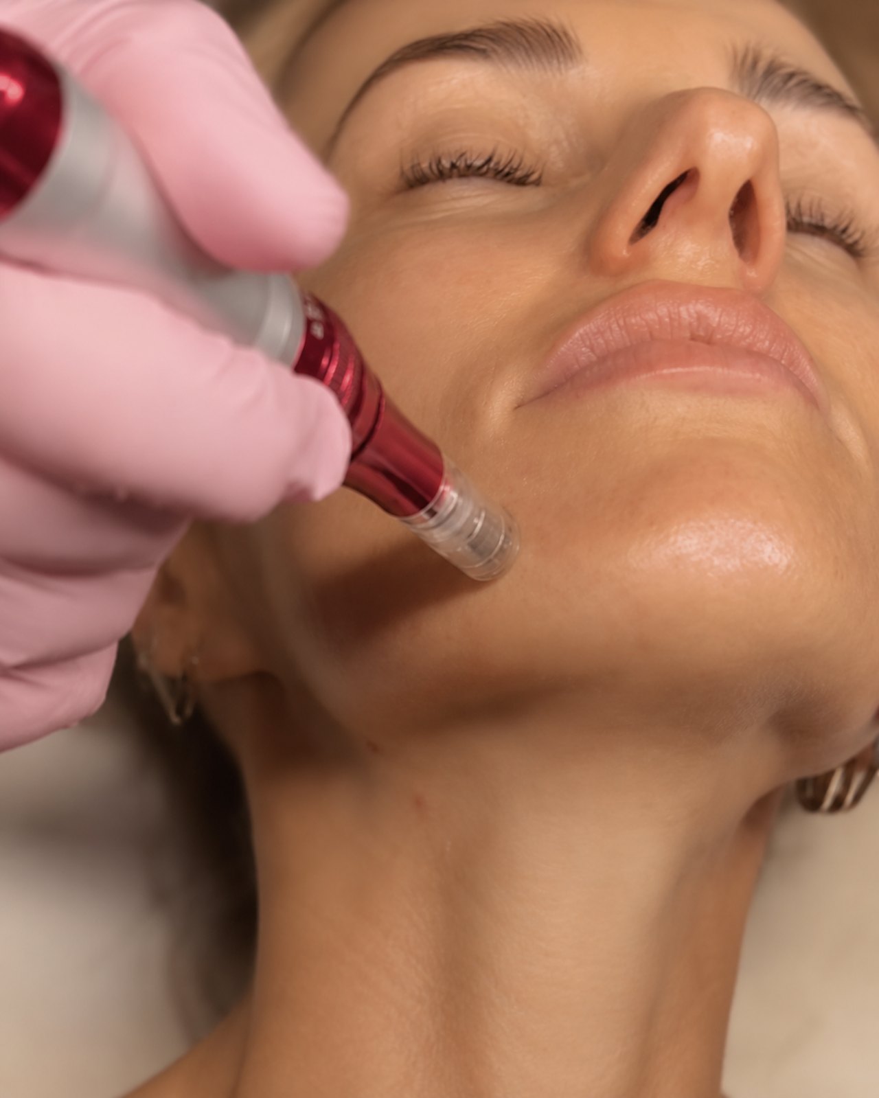Microneedling-Behandlung im Gesicht bei SWON, Nahaufnahme der Hautverfeinerung