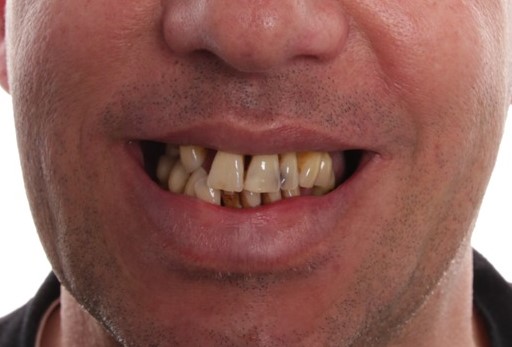 Ausgangssituation vor der Sofortversorgung von Ober- und Unterkiefer bei ADU-Dental