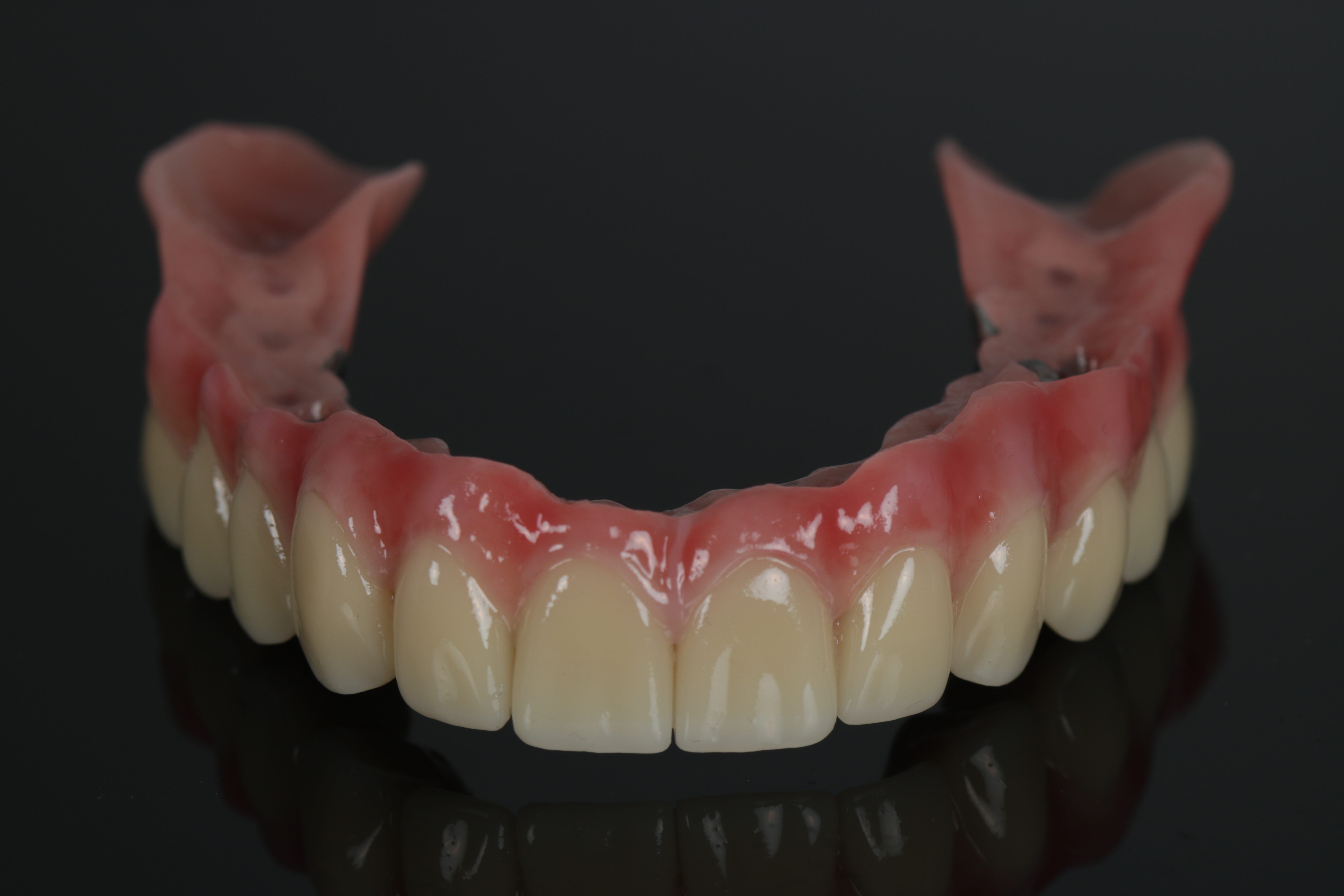 Teleskoparbeit für den Oberkiefer aus Titan-Legierung, gefräst, von ADU-Dental