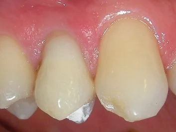 Internes Bleaching – Nachher