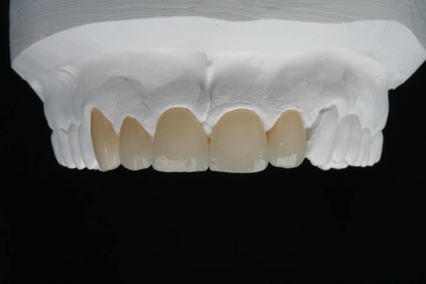 Zirkonkronen und Brücken von ADU-Dental
