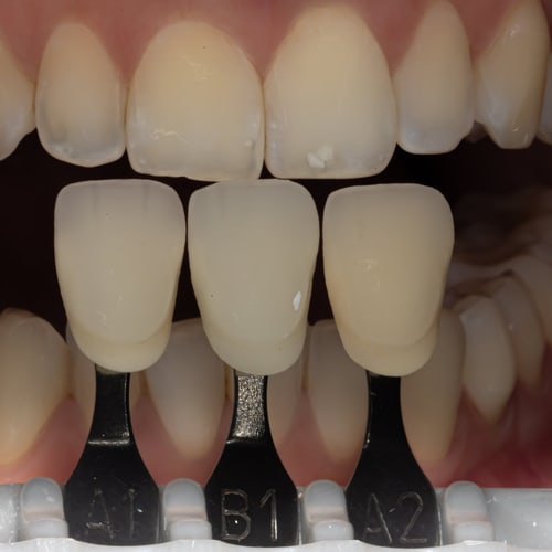 Dentalfoto: Zahnfarbbestimmung