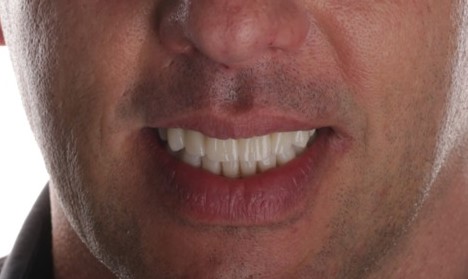 Vollversorgung von Ober- und Unterkiefer am Tag des Eingriffs, gefertigt von ADU-Dental