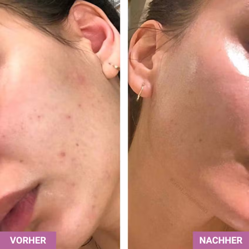 Vorher-Nachher-Vergleich einer Gesichtshälfte mit Hautunreinheiten und danach mit klarer, glatter Haut.