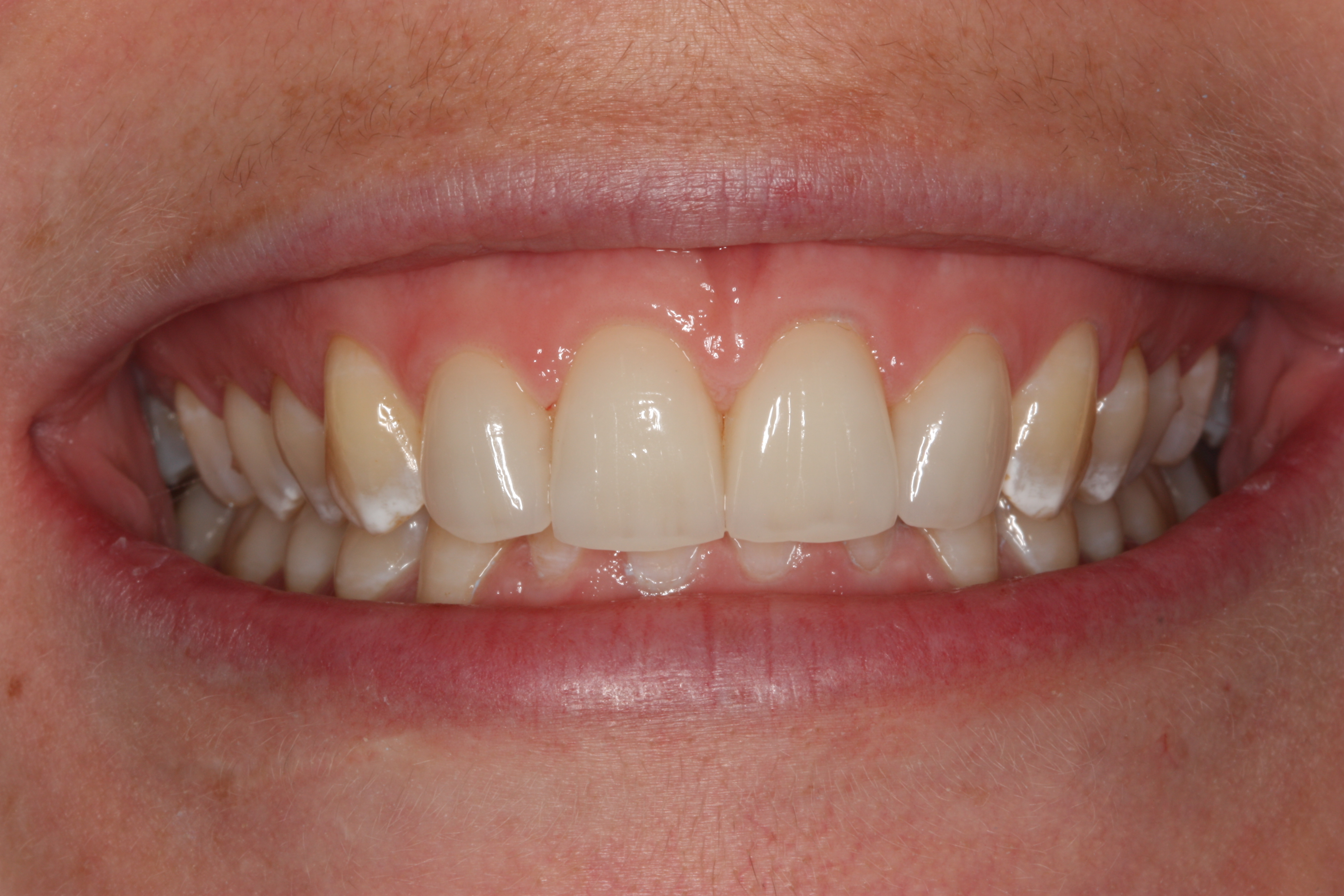Kronenverlängerung und vier Veneers – Nachher