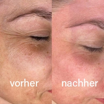 Vorher-Nachher Hautergebnis