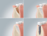 Vier Phasen der Sinusbodenelevation mit Knochenaufbau und anschließender Implantatinsertion.