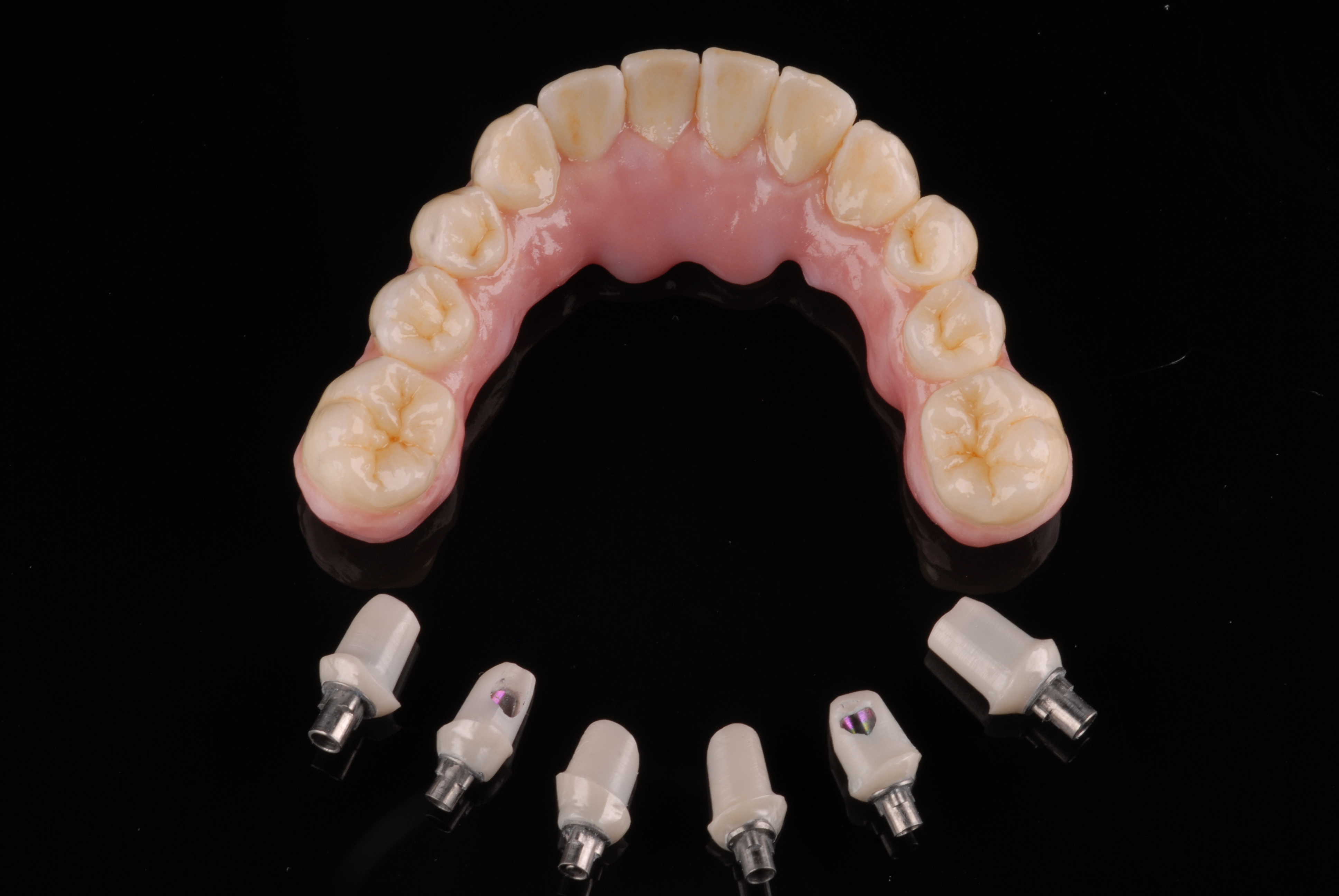 Zirkonbrücke für den Unterkiefer auf sechs individuellen Abutments von ADU-Dental