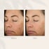 Laser hair removal treatment for smooth and hair-free skin