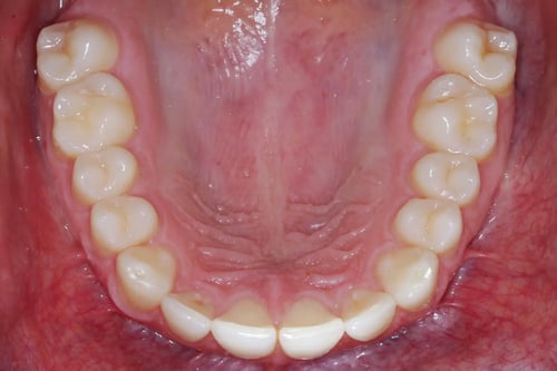 dental-photo-systeme_Okklusalspiegel_1
