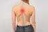 Back with visible spine and curve, illustrating scoliosis condition.
