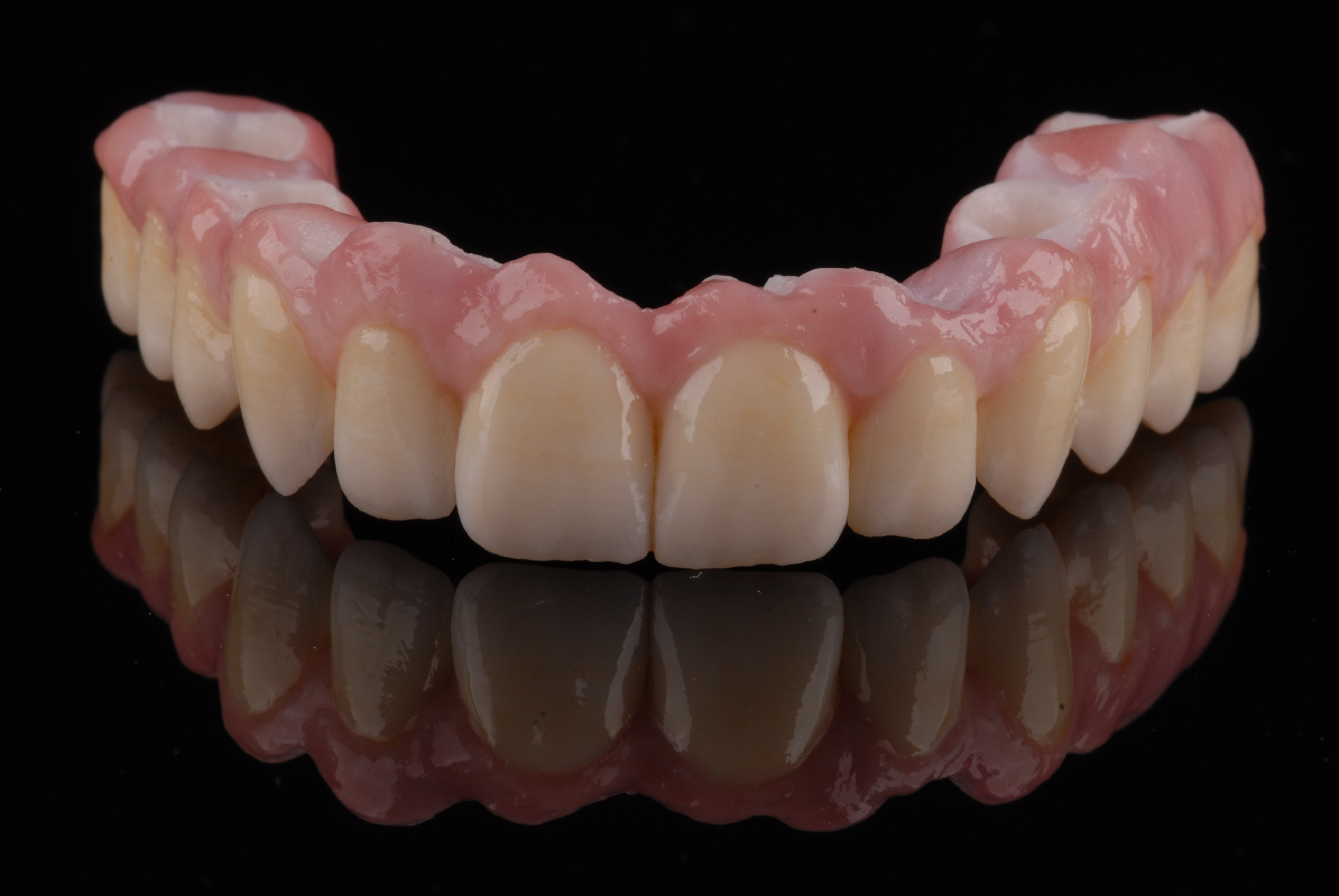 Implantatgetragene Oberkieferversorgung aus dem Dentallabor ADU-Dental in Göggingen
