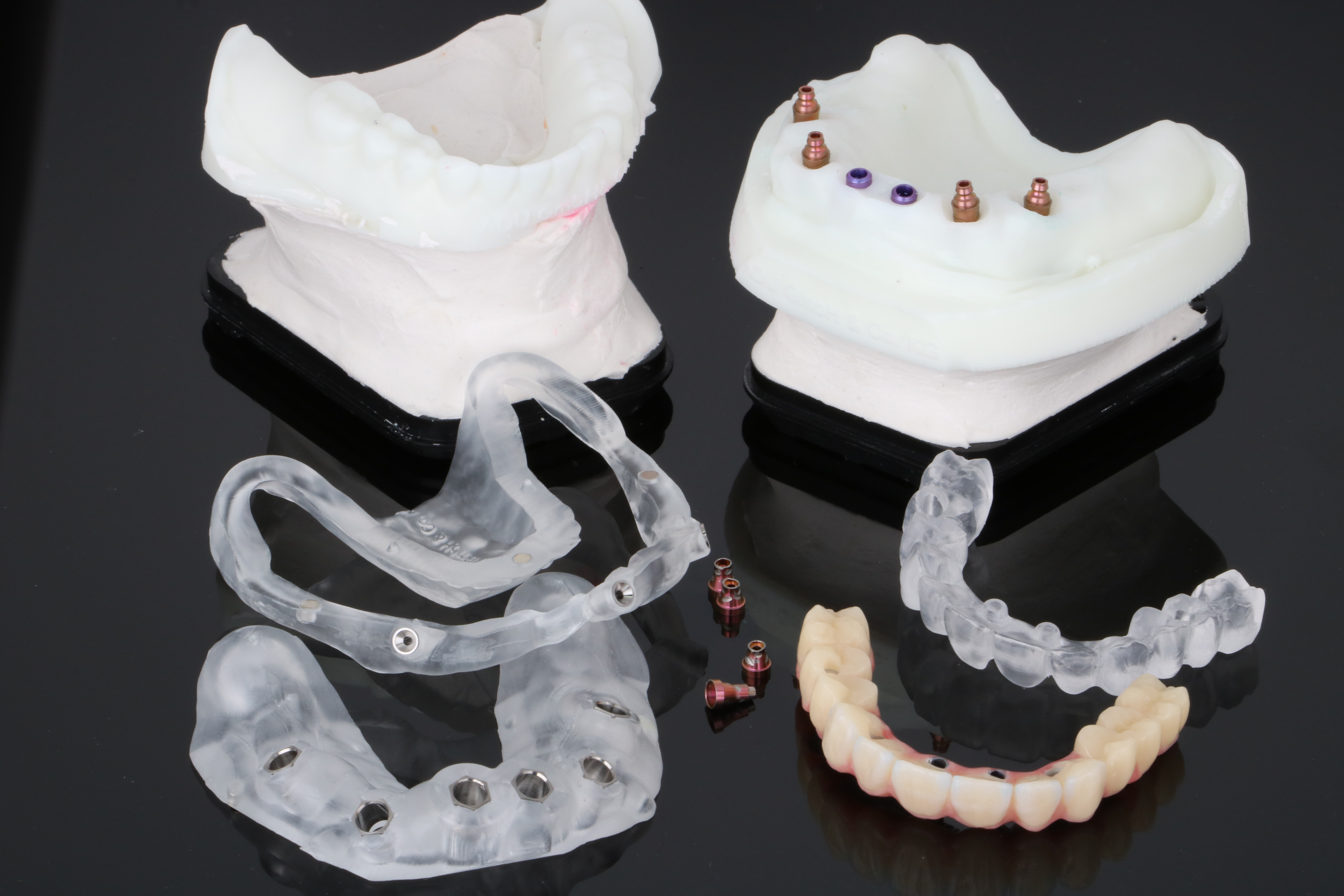 Geteilte Bohrschablone, Modelle und Provisorium für die navigierte Implantation mit Sofortversorgung von ADU-Dental