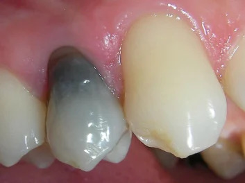 Internes Bleaching – Vorher