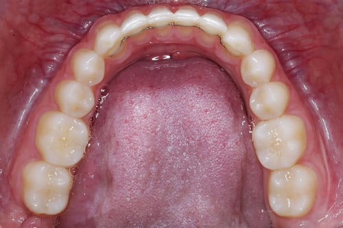 dental-photo-systeme_Okklusalspiegel_2