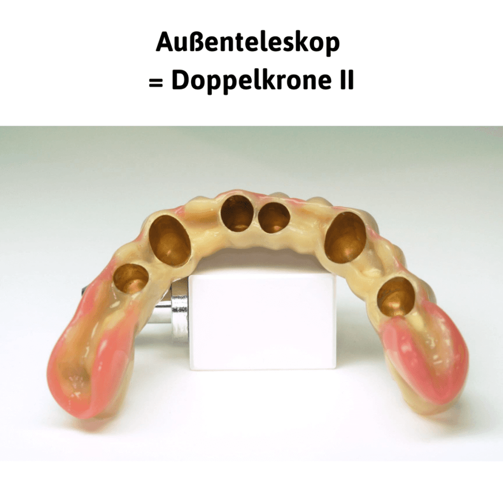 Außenteleskop = Doppelkrone II: die herausnehmbare Zahnreihe