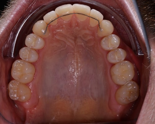 Dentalfoto: Oberkiefer okklusal