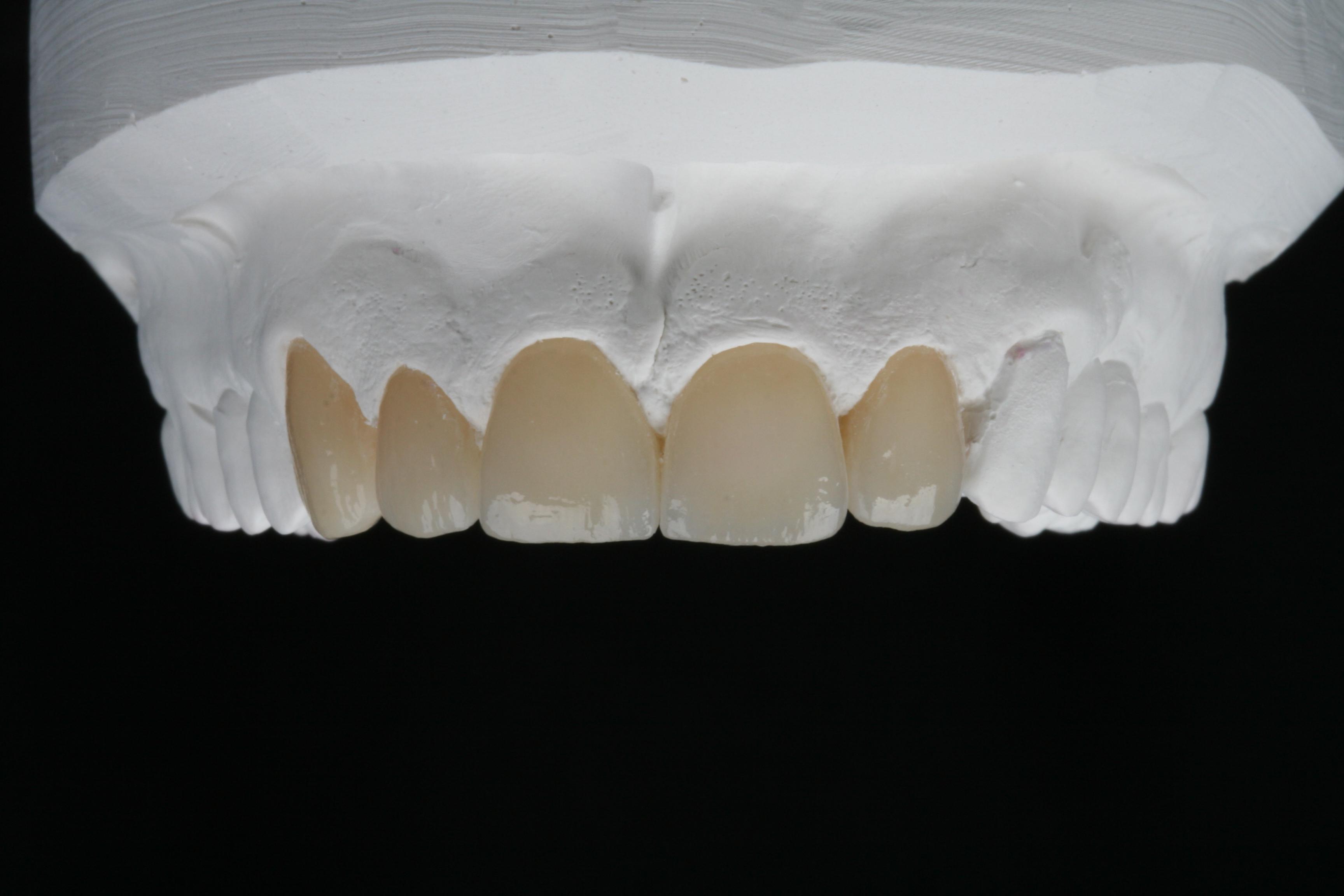 Zirkonkronen und Brücken von ADU-Dental
