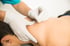 Patient Receiving Acupuncture Therapy 