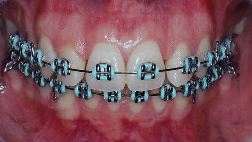 Dentalfoto: Zähne mit Zahnspange