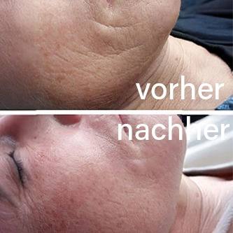 Vorher-Nachher Hautergebnis