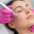 Microneedling Behandlung 