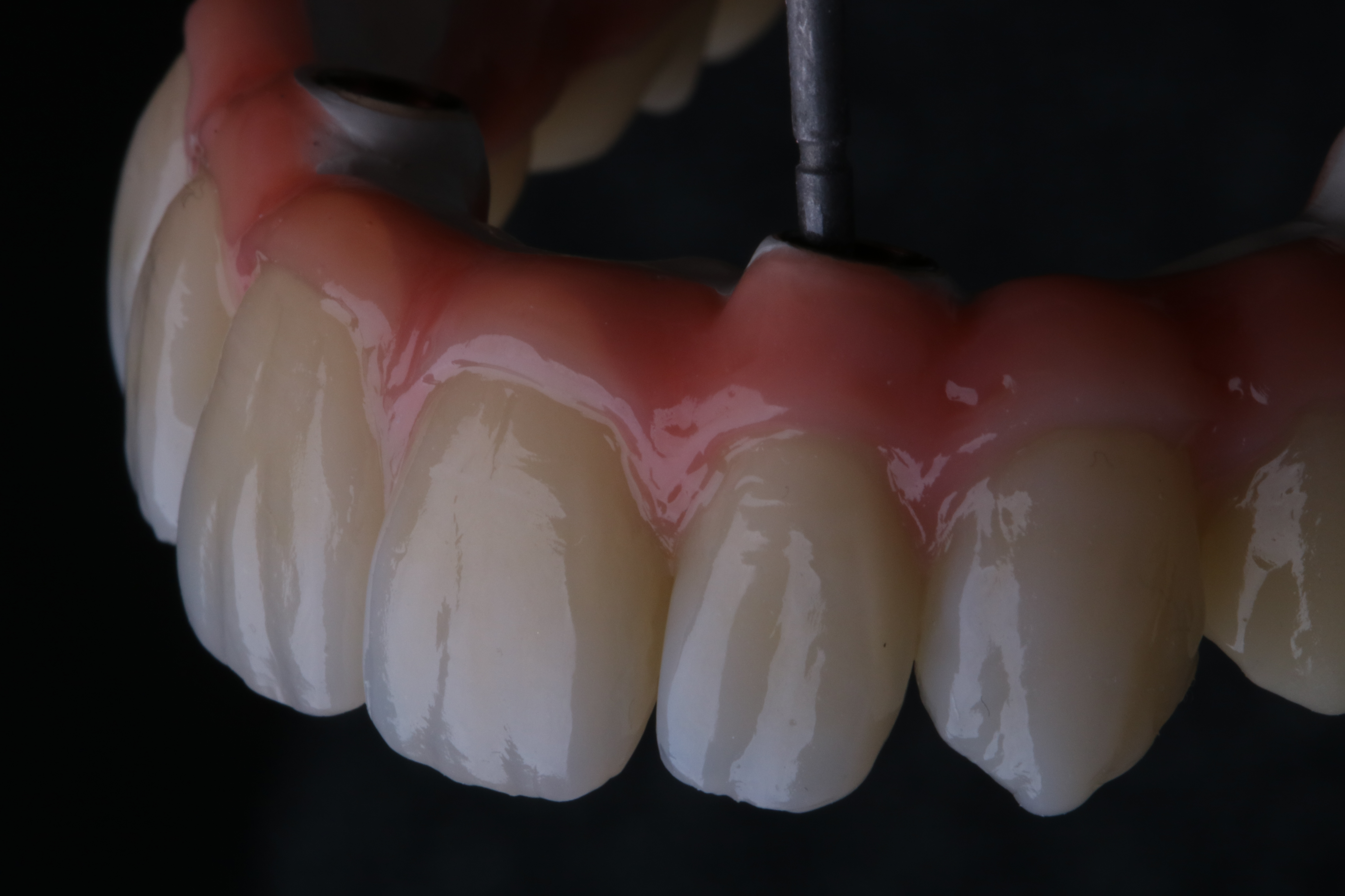 Titan-Teleskoparbeit von ADU-Dental