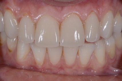 Veneers – Nachher