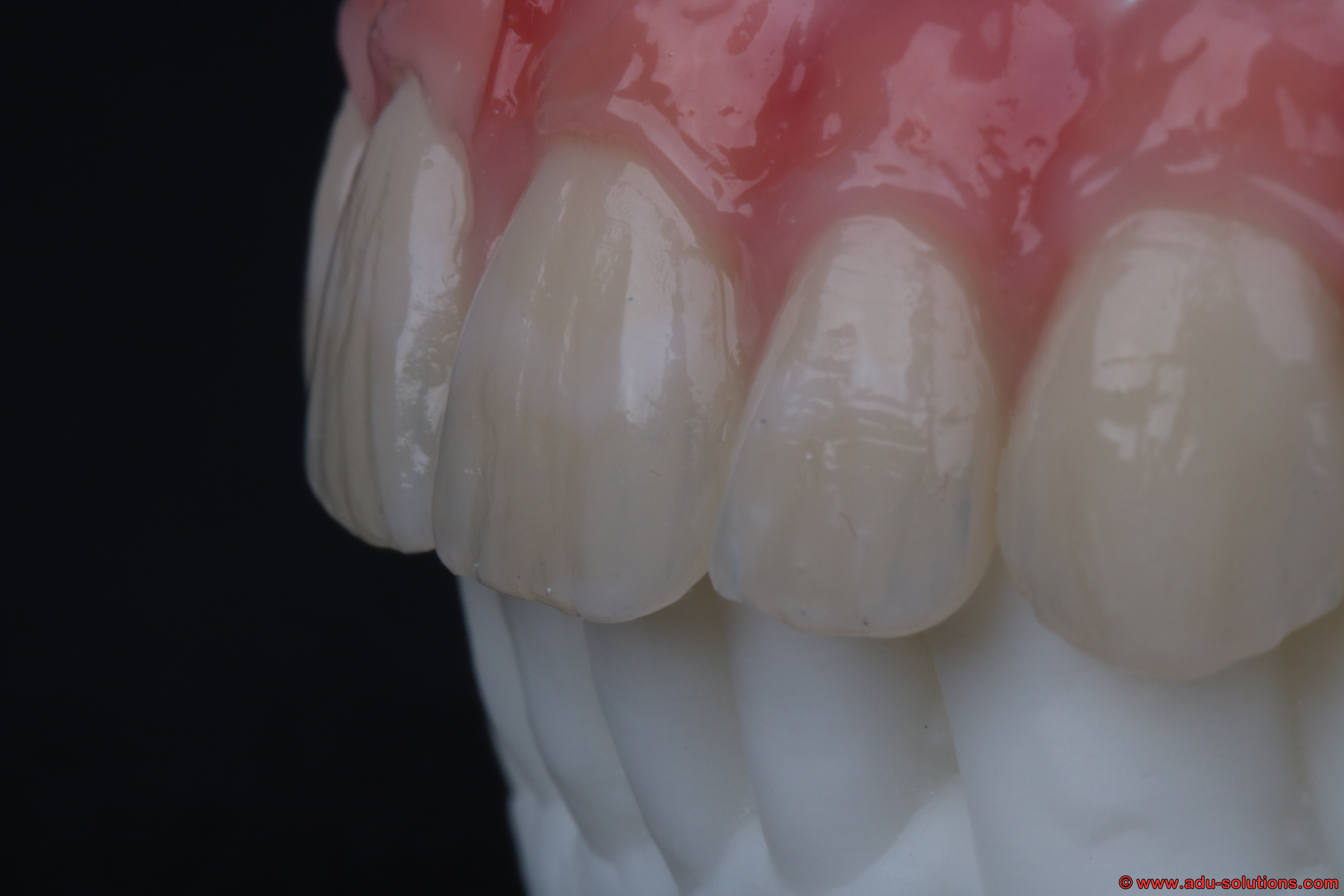 Nahaufnahme einer verschraubten implantatgetragenen Versorgung von ADU-Dental