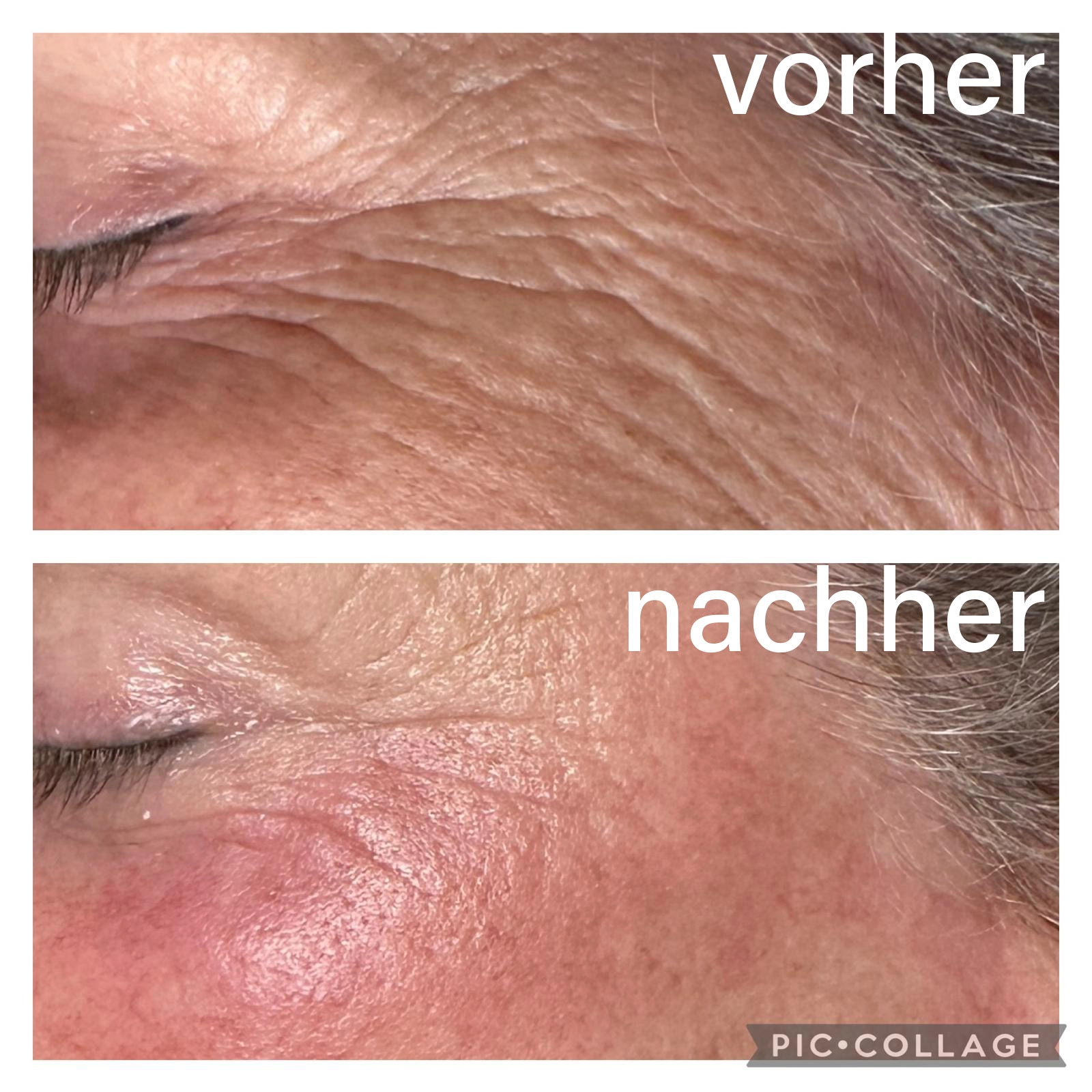 Vorher-Nachher Hautergebnis