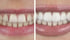Mit und ohne Veneers