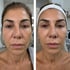 Vorher-Nachher-Vergleich einer Frau mit weniger Falten und strafferer Haut im Gesicht nach einer Behandlung.