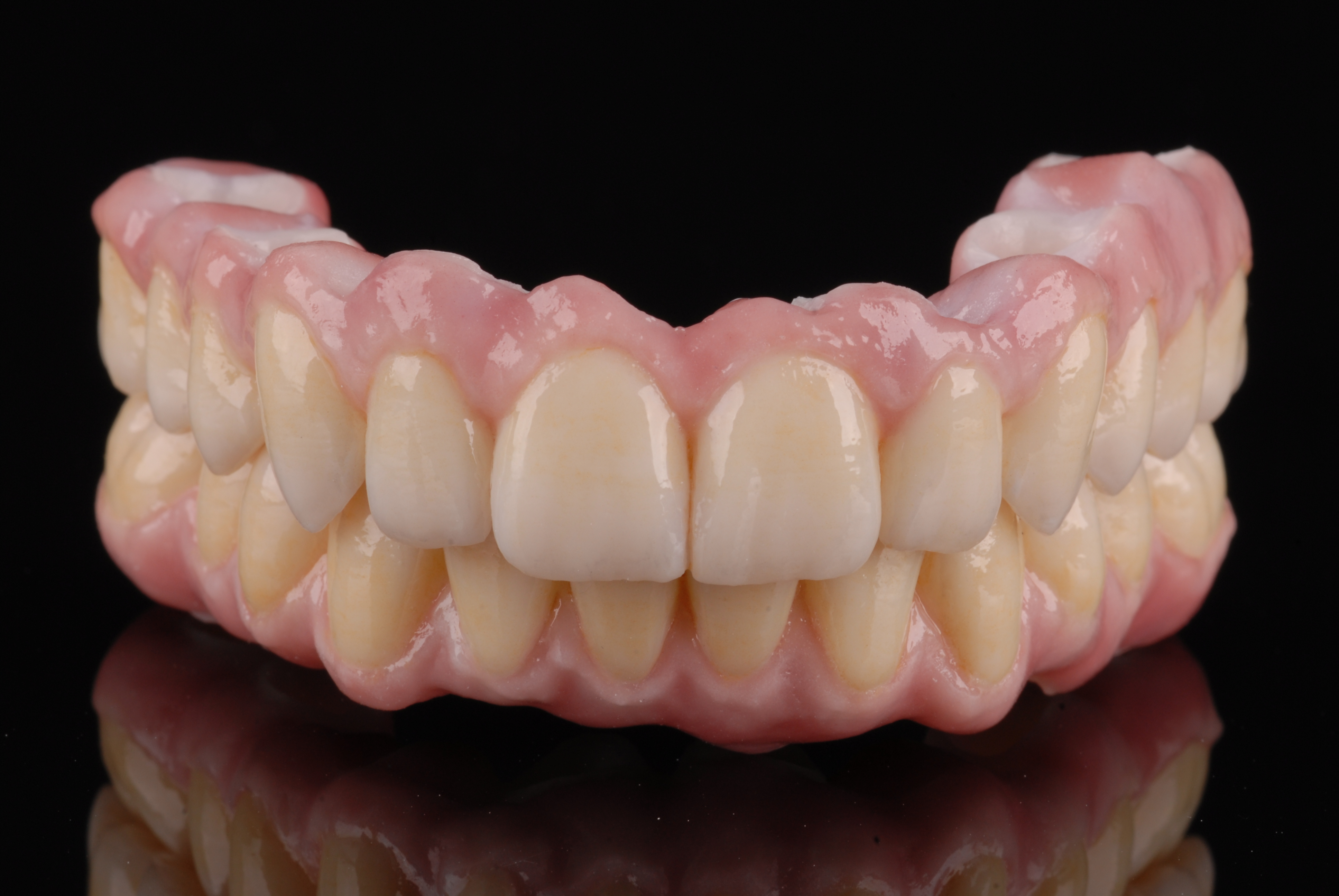 Ober- und Unterkieferversorgung auf jeweils sechs Implantaten, verschraubt, gefertigt von ADU-Dental in Göggingen
