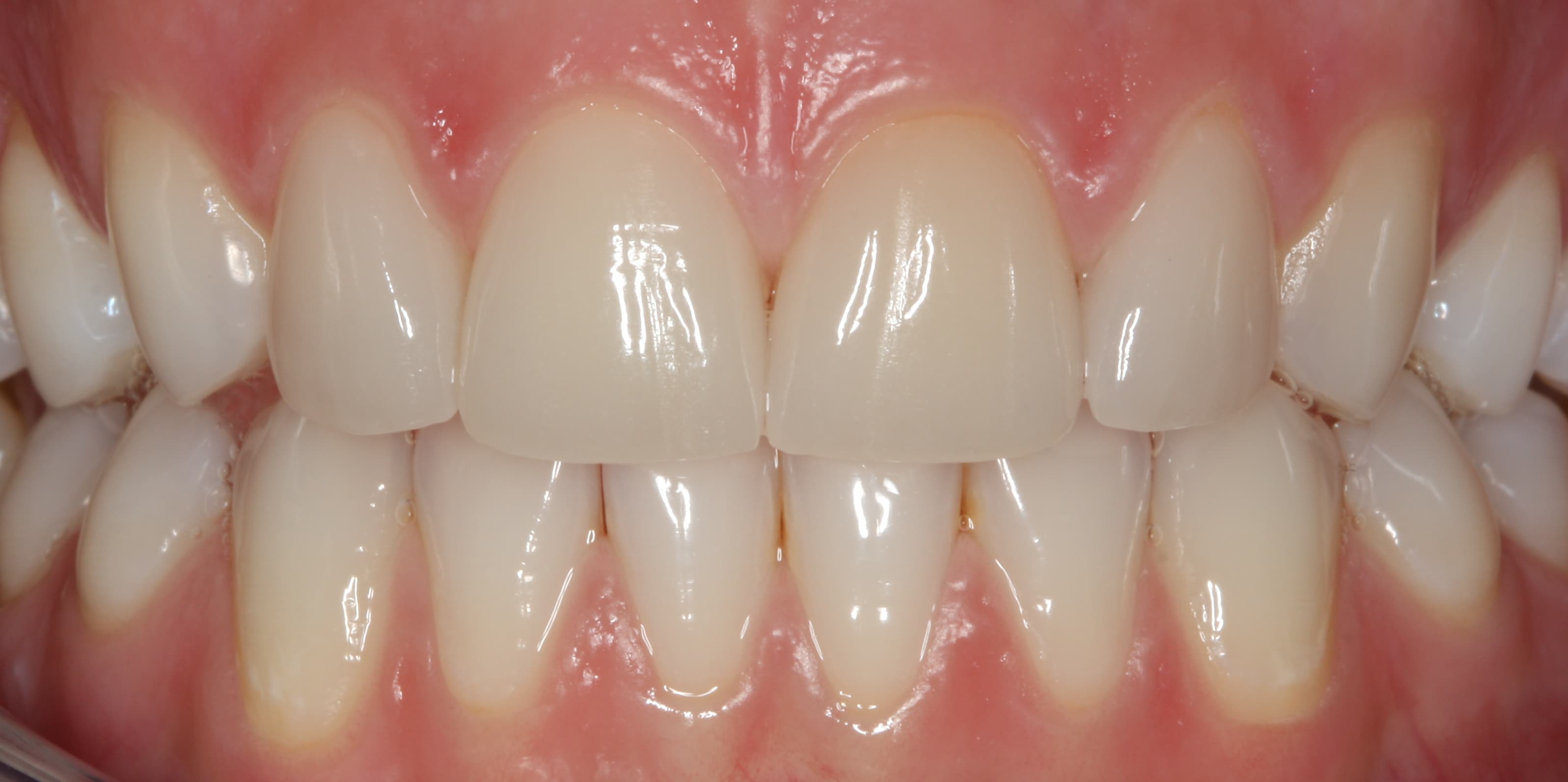 Veneers – Nachher