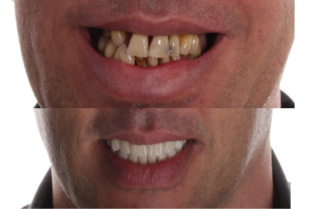 Implantatgetragene Komplettversorgung von ADU-Dental, Vorher-Nachher-Vergleich