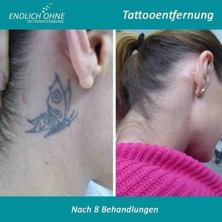 Schmetterling-Tattoo am Hals vor und nach acht Laserbehandlungen