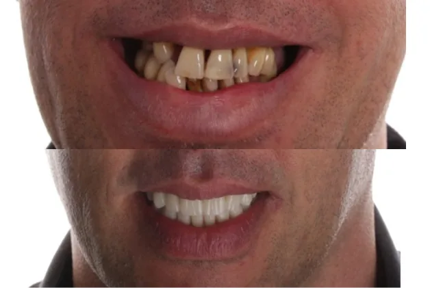 Implantatgetragene Komplettversorgung von ADU-Dental, Vorher-Nachher-Vergleich