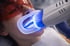 Person mit orangefarbener Schutzbrille erhält Zahnaufhellung mit blauem LED-Licht und Mundspreizer.