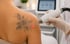 Tattoo Entfernung im Schulterbereich mit moderner Lasertechnologie