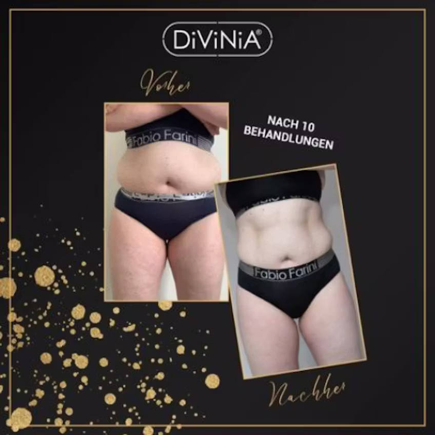 Vorher-Nachher-Vergleich des Bauches einer Person in schwarzer Unterwäsche, nach 10 Behandlungen.