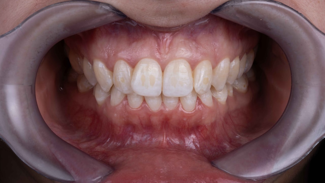 Dentalfoto: Frontalansicht mit Wangenhaltern