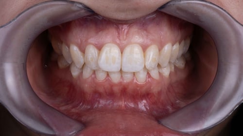 Dentalfoto: Frontalansicht mit Wangenhaltern