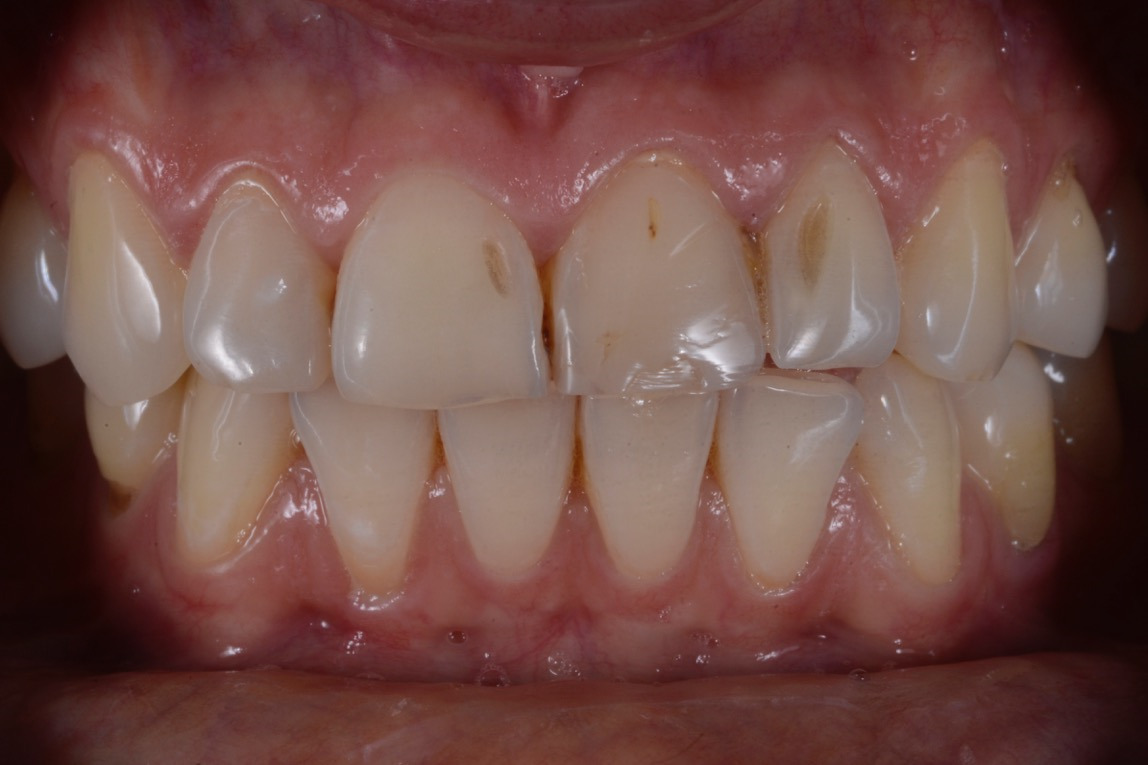 Veneers – Vorher