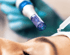 Hautbehandlung mit Microneedling-Gerät und Pipette, die einen Tropfen Flüssigkeit auf die Haut gibt.