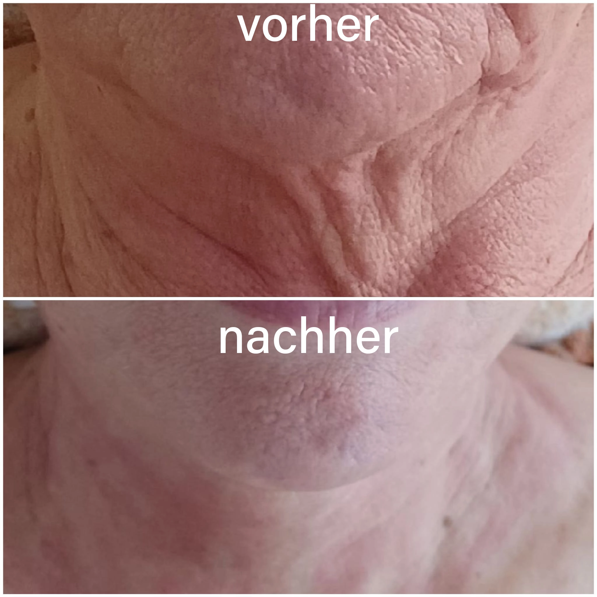 Vorher-Nachher Hautergebnis