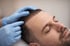 Präzise Haarlinienplanung bei Haartransplantation in Zwickau
