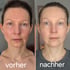 Vorher-Nachher-Vergleich einer Frau; links mit geröteter Haut ("vorher"), rechts mit klarerer Haut ("nachher").