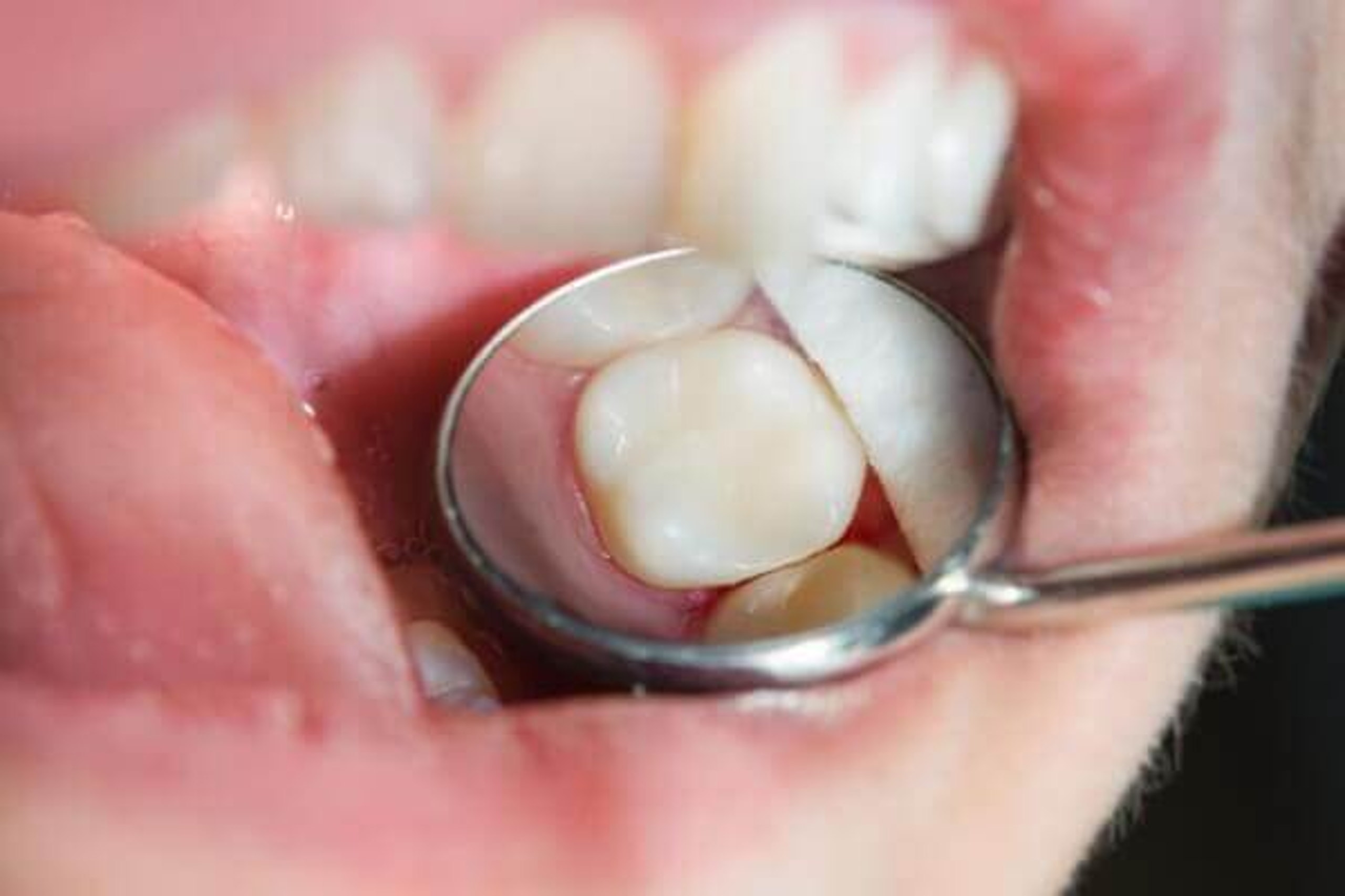Fertig versorgter Zahn nach der CEREC-Behandlung
